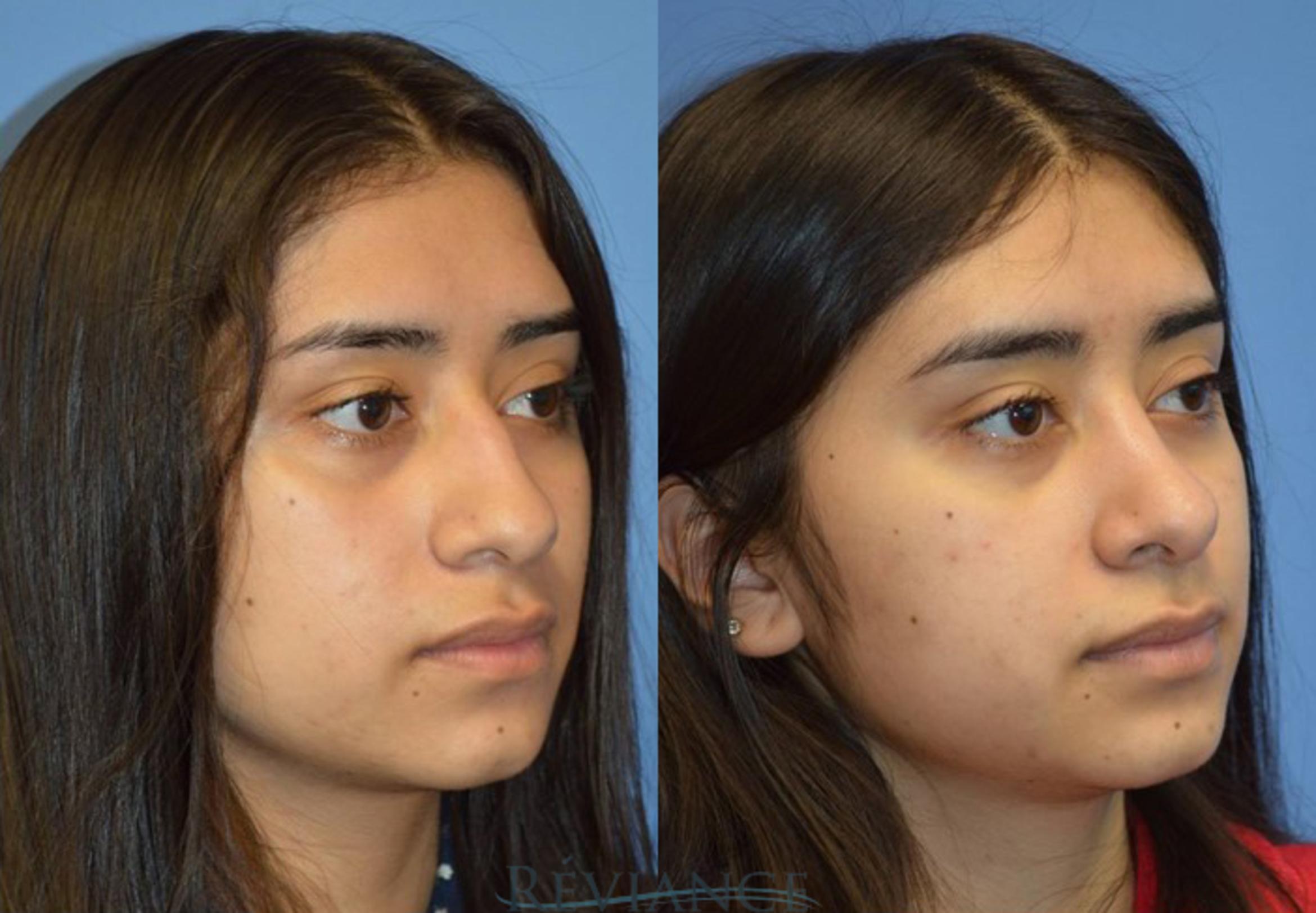 Before & After Rhinoplasty Case 2186 View #1 View in Portland, OR