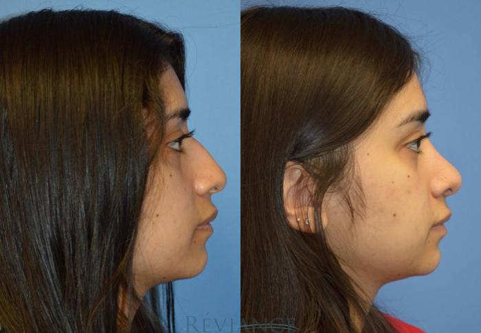 Before & After Rhinoplasty Case 2186 View #2 View in Portland, OR