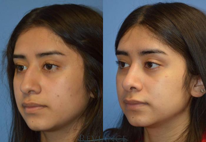 Before & After Rhinoplasty Case 2186 View #3 View in Portland, OR