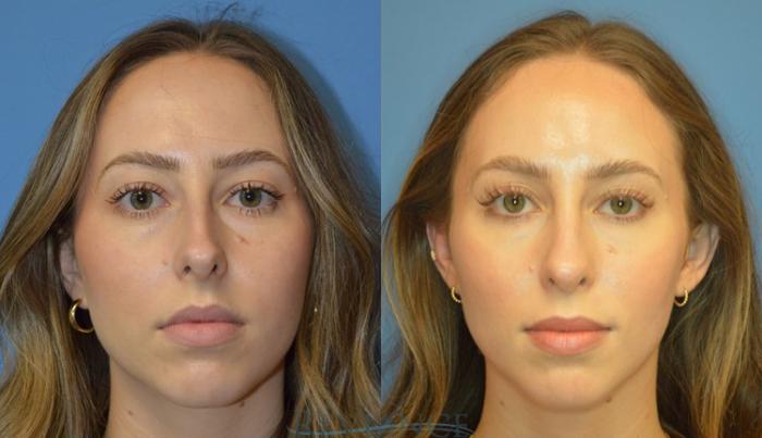 Before & After Rhinoplasty Case 2199 View #1 View in Portland, OR