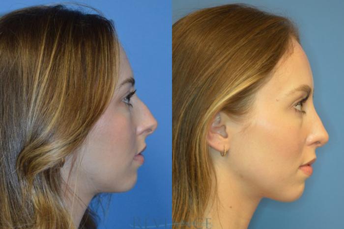 Before & After Rhinoplasty Case 2199 View #2 View in Portland, OR