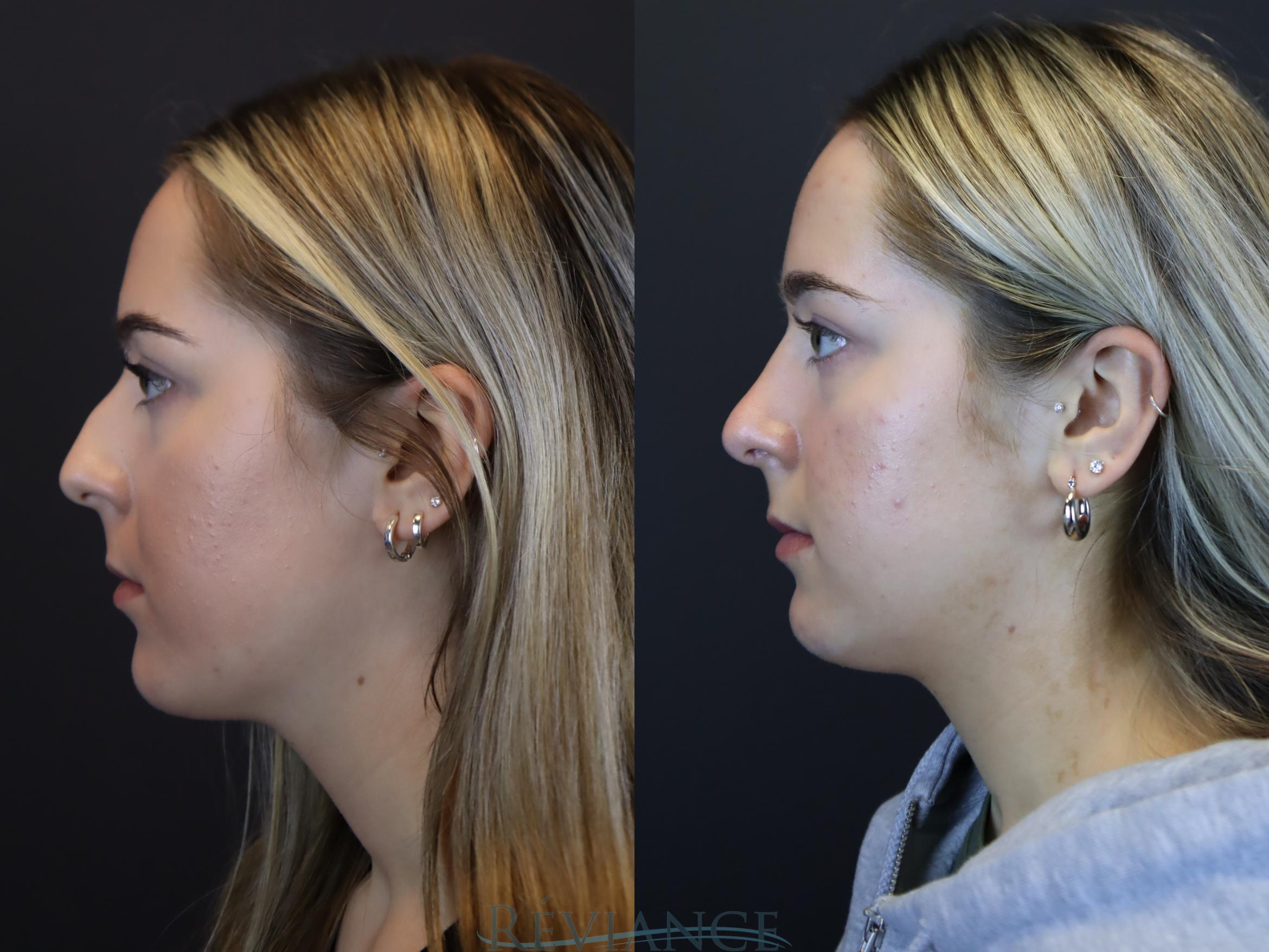 Rhinoplasty, dorsal hump reduction