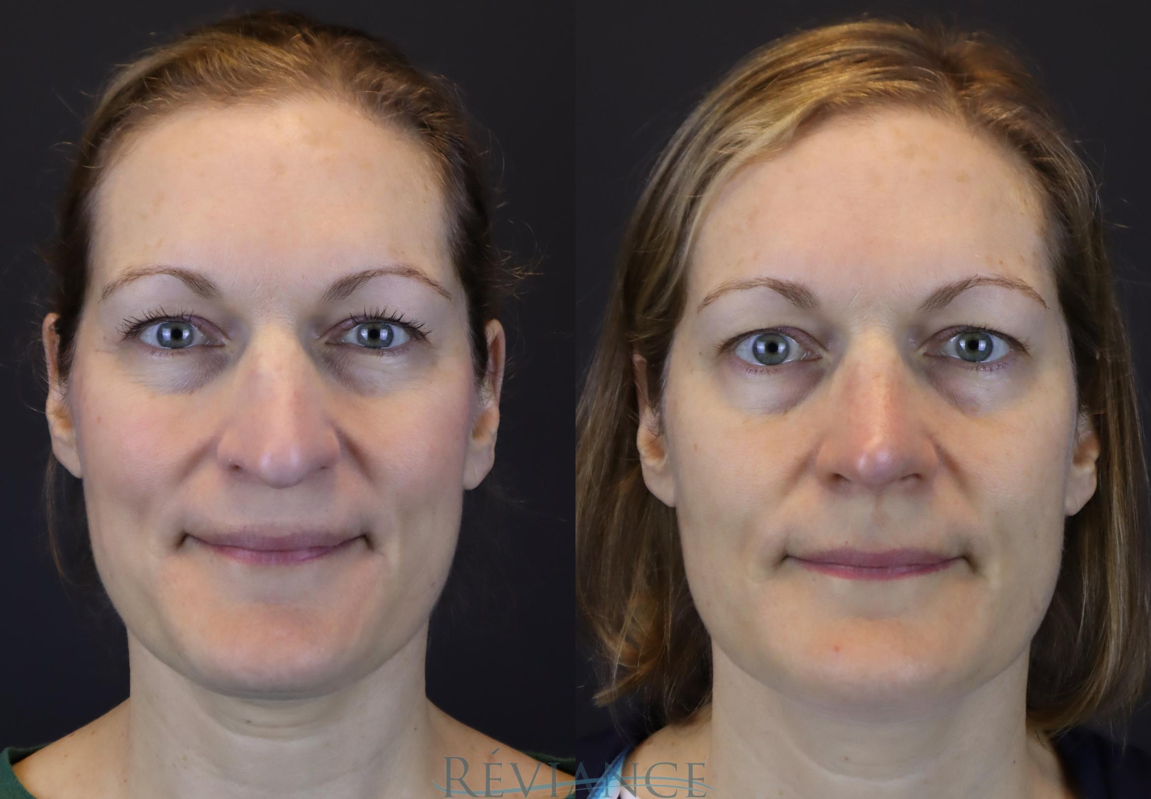 Before & After Rhinoplasty Case 2216 Front View in Portland, OR