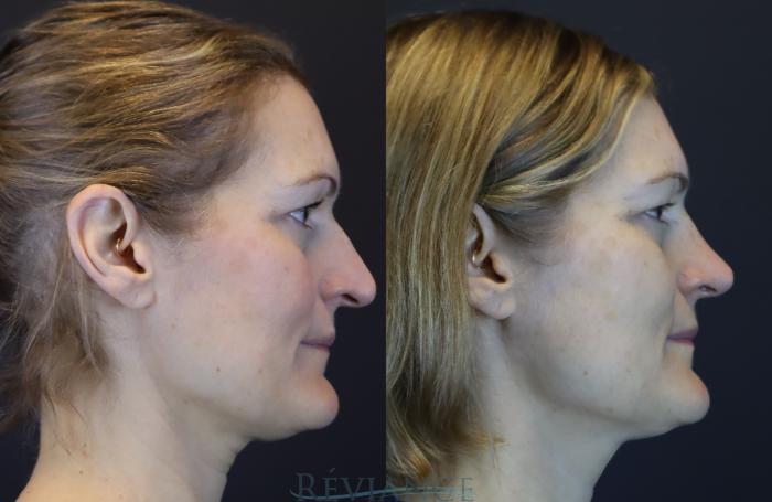 Before & After Rhinoplasty Case 2216 Right Side View in Portland, OR