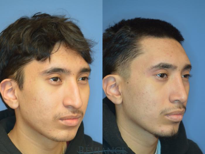 Before & After Rhinoplasty Case 2235 1/4 View in Portland, OR
