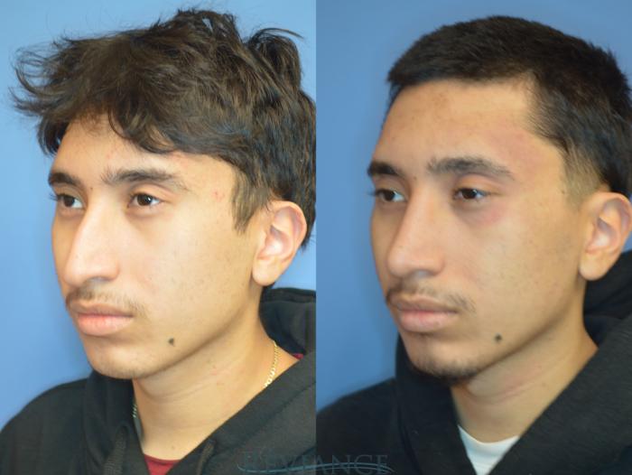 Before & After Rhinoplasty Case 2235 3/4 View in Portland, OR