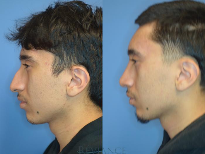 Before & After Rhinoplasty Case 2235 Left Side View in Portland, OR