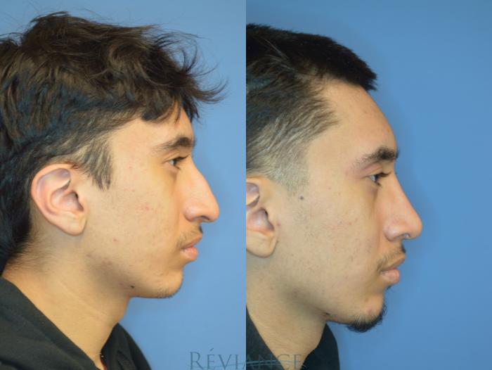 Before & After Rhinoplasty Case 2235 Right Side View in Portland, OR