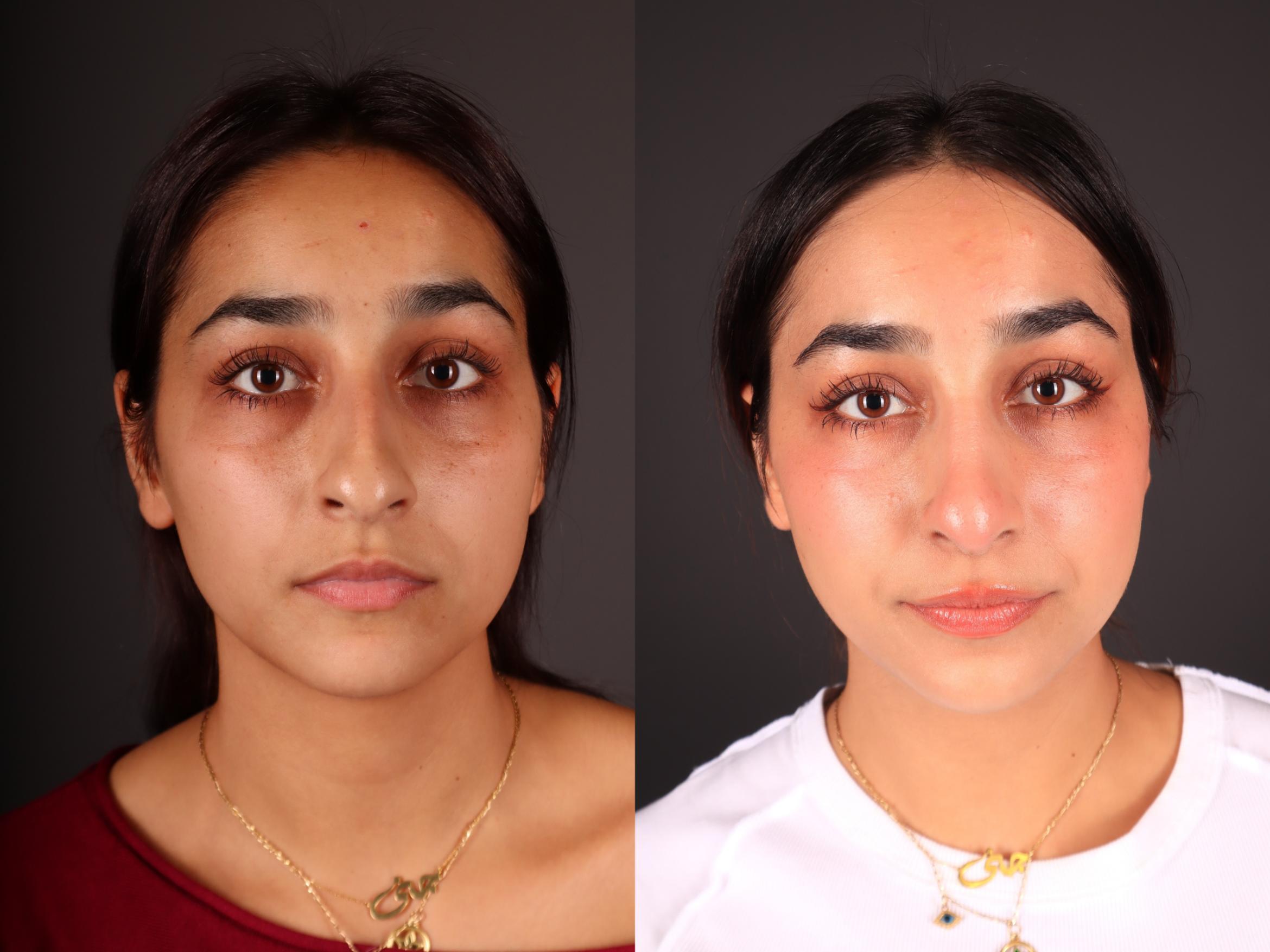 Before & After Rhinoplasty Case 2246 Front View in Portland, OR