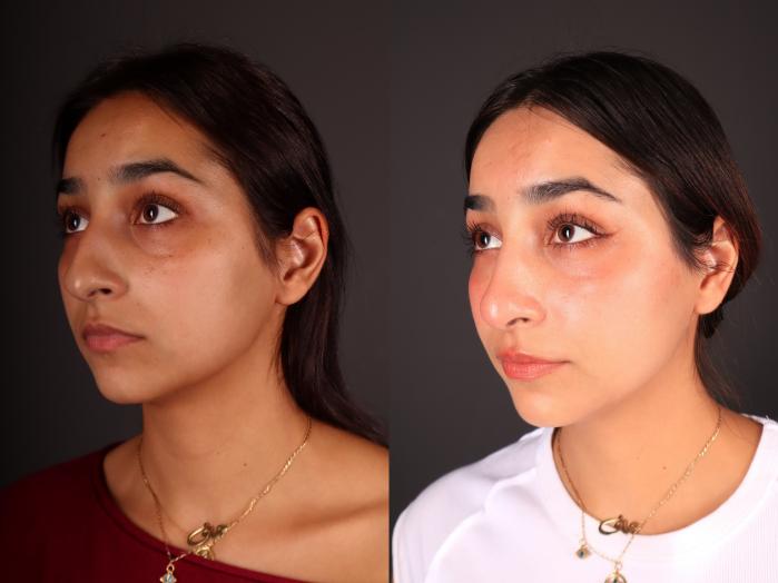 Before & After Rhinoplasty Case 2246 Left Oblique View in Portland, OR