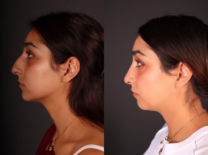Before & After Rhinoplasty Case 2246 Left Side View in Portland, OR