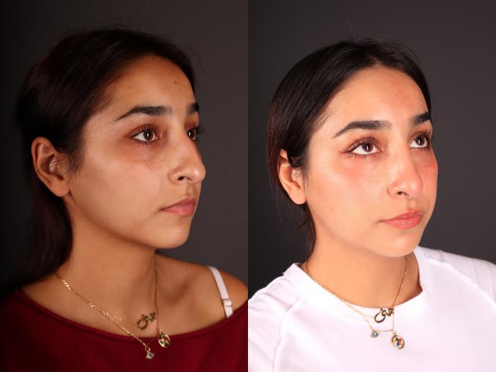 Before & After Rhinoplasty Case 2246 Right Oblique View in Portland, OR
