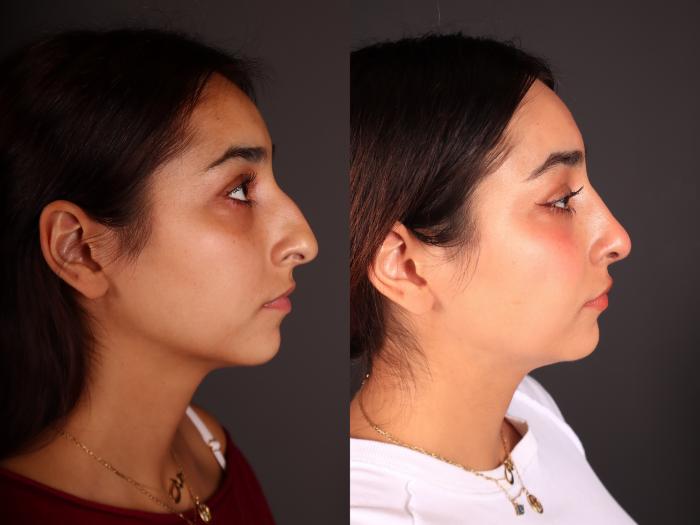 Before & After Rhinoplasty Case 2246 Right Side View in Portland, OR