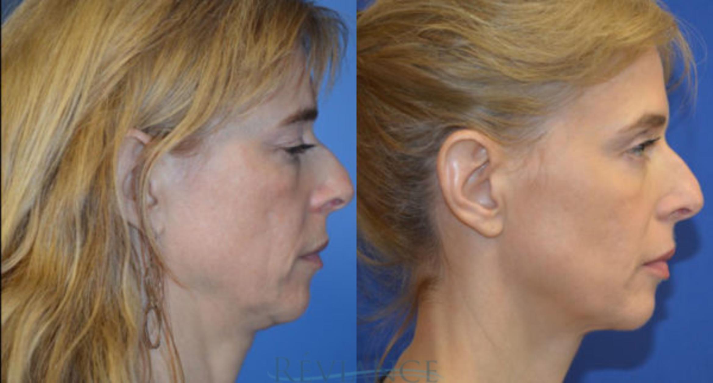Before & After Ultherapy (Ultrasound Face-lift) Case 1359 View #1 View in Portland, OR