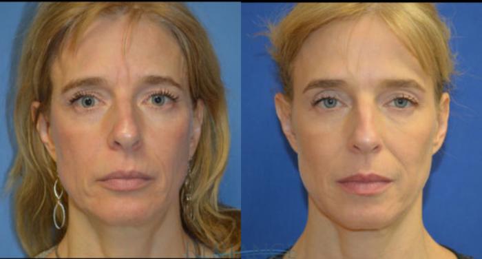 Before & After Ultherapy (Ultrasound Face-lift) Case 1359 View #2 View in Portland, OR