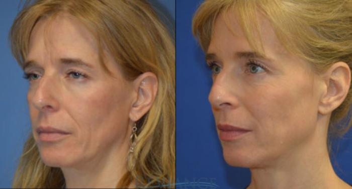 Before & After Ultherapy (Ultrasound Face-lift) Case 1359 View #3 View in Portland, OR