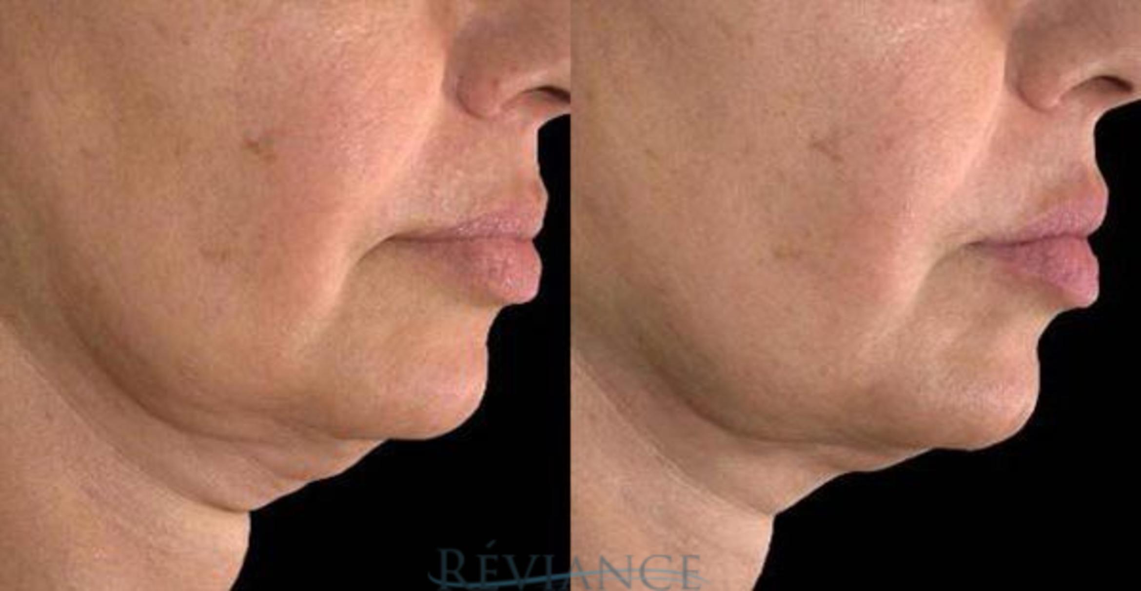 Before & After Ultherapy (Ultrasound Face-lift) Case 197 View #1 View in Portland, OR