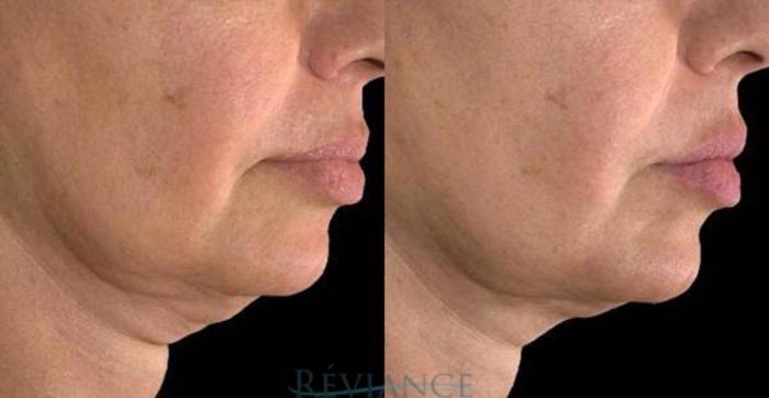 Before & After Ultherapy Case 197 View #1 View in Portland, OR