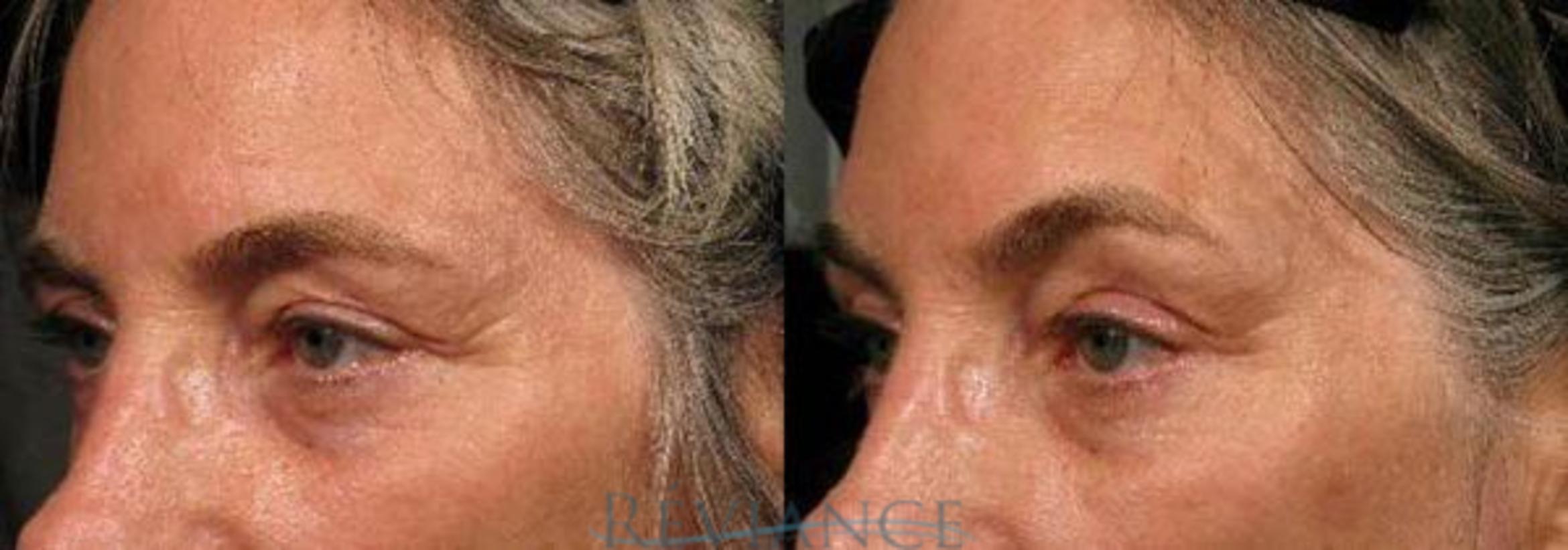 Before & After Ultherapy Case 201 View #1 View in Portland, OR