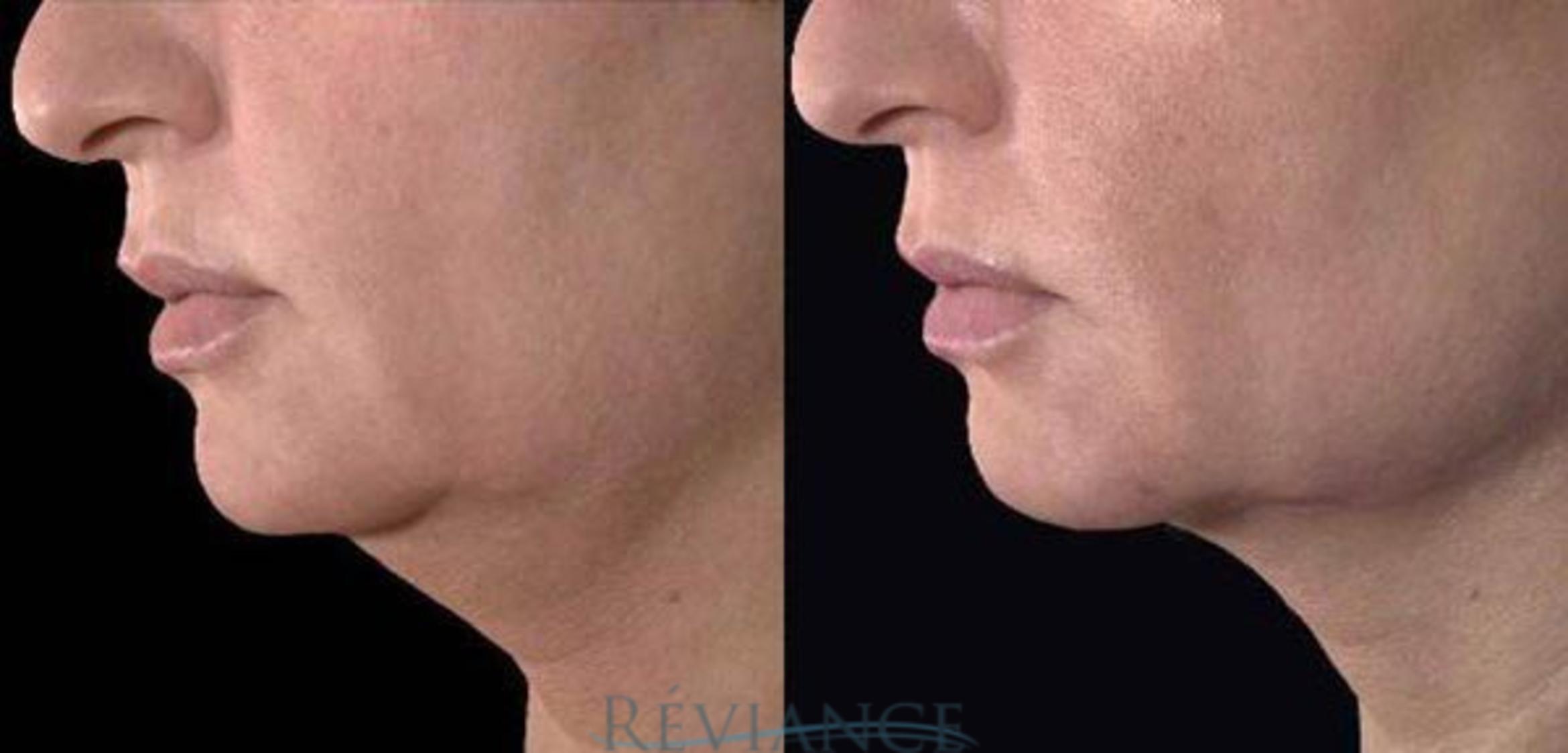 Before & After Ultherapy (Ultrasound Face-lift) Case 205 View #1 View in Portland, OR
