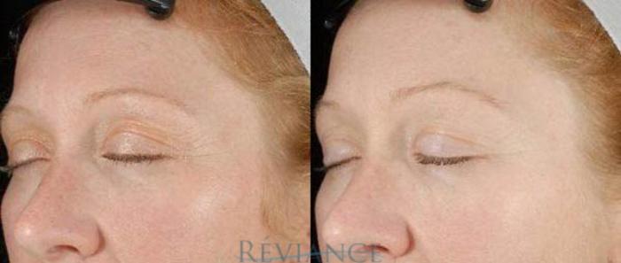 Before & After Ultherapy (Ultrasound Face-lift) Case 209 View #1 View in Portland, OR