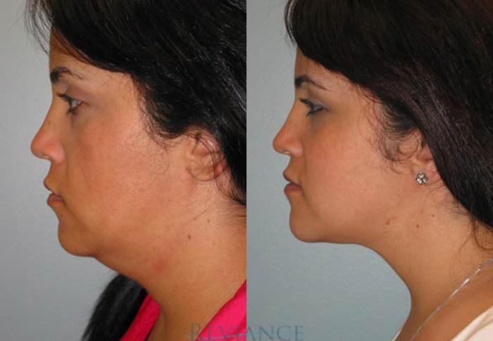 Before & After Ultherapy (Ultrasound Face-lift) Case 213 View #2 View in Portland, OR