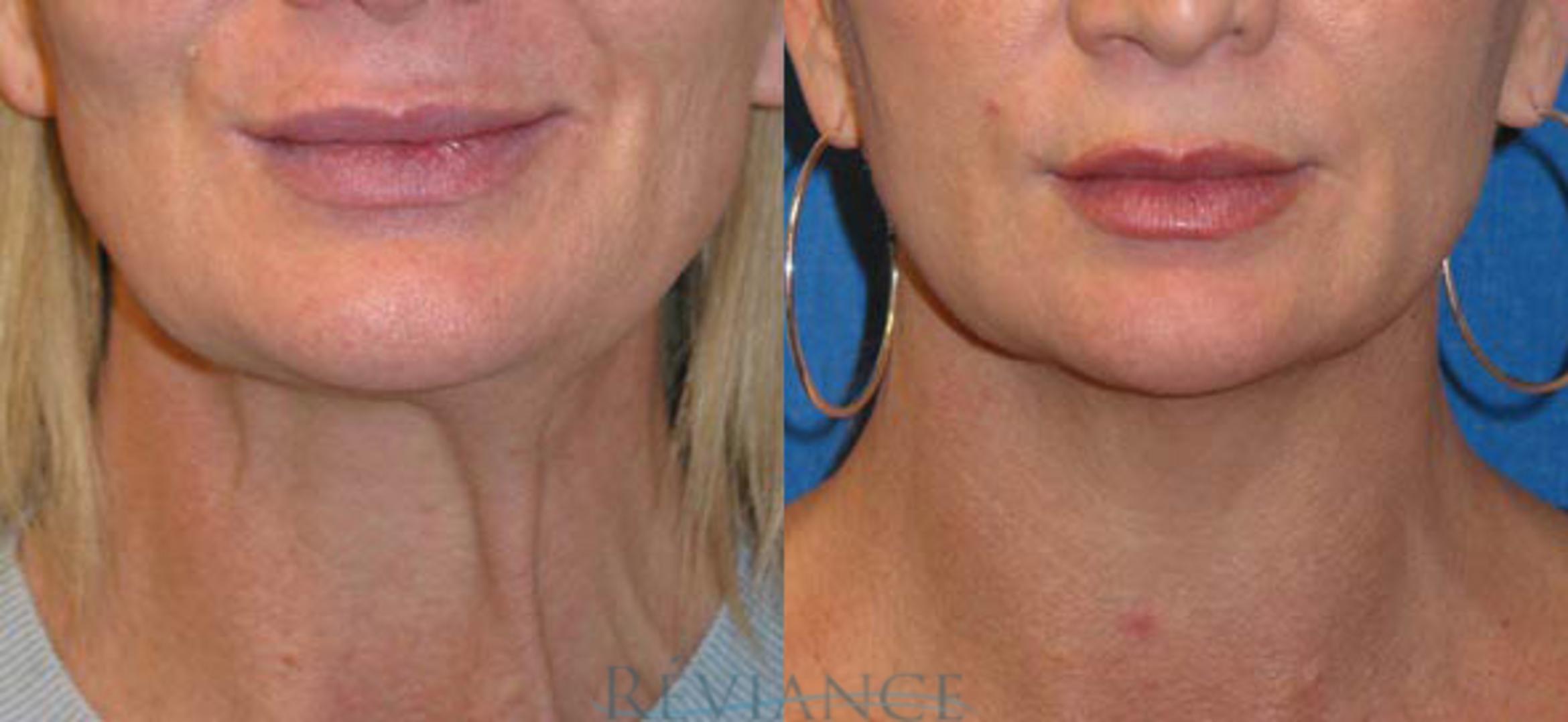 Before & After Ultherapy (Ultrasound Face-lift) Case 219 View #1 View in Portland, OR