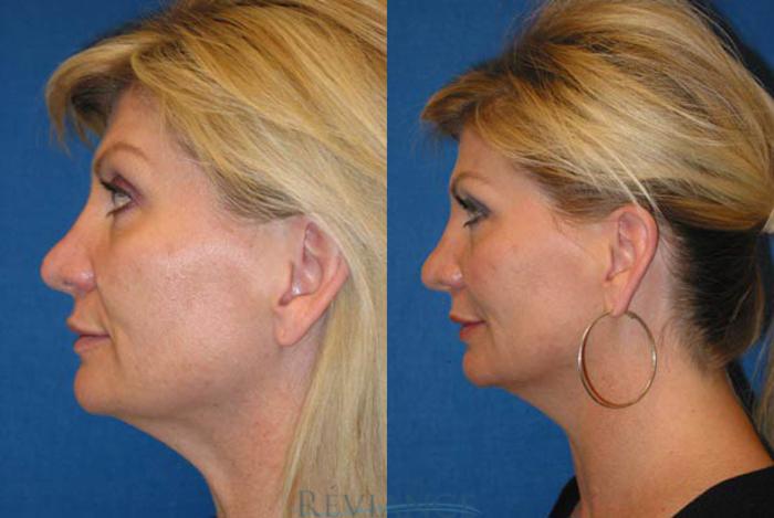 Before & After Ultherapy (Ultrasound Face-lift) Case 219 View #2 View in Portland, OR