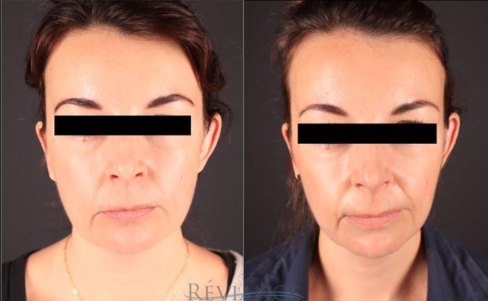 Before & After Ultherapy (Ultrasound Face-lift) Case 2247 Front View in Portland, OR