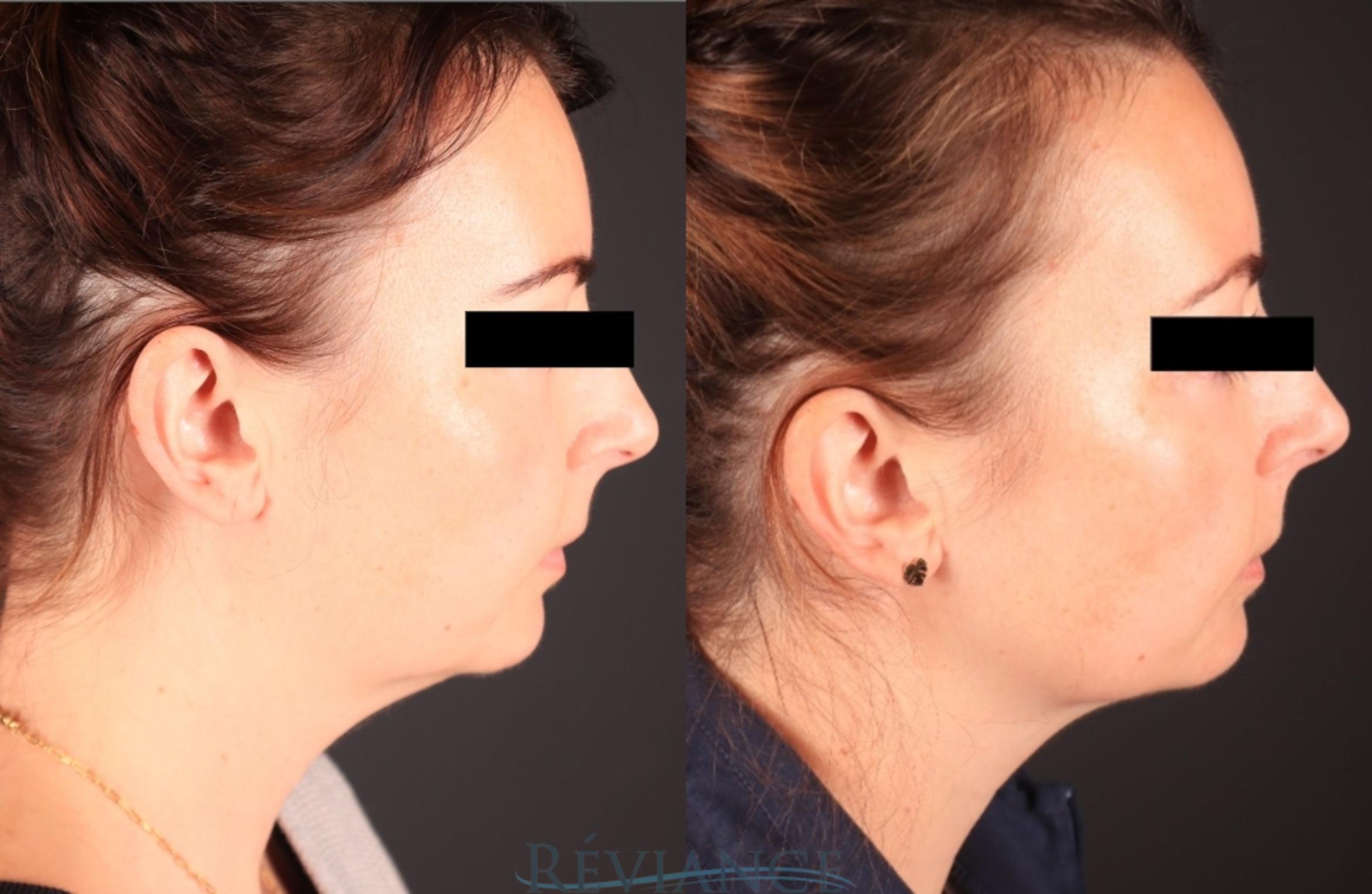 Before & After Ultherapy (Ultrasound Face-lift) Case 2247 Left Side View in Portland, OR